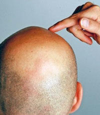 Кариес и выпадение волос вызваны одной и той же причиной - исследование
