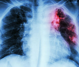 ВОЗ допускает резкий рост смертности от туберкулеза