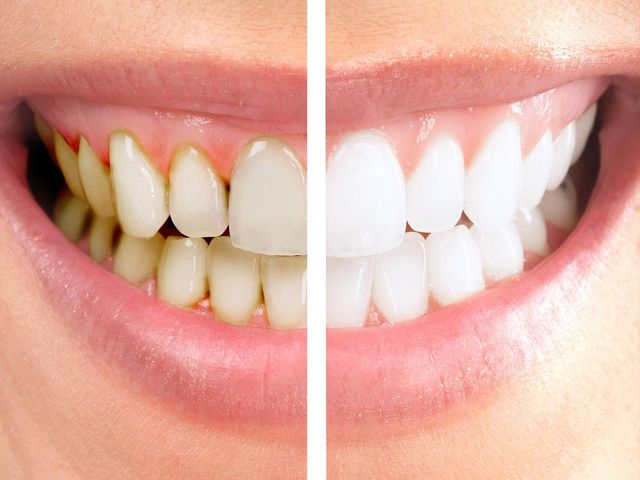 Снятие (удаление) зубных отложений Цены на гигиеническую чистку зубов.