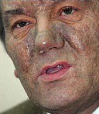 Ющенко разрешил использовать результаты своего отравления в научных целях